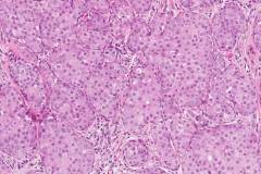 Apocrine type intraductal carcinoma