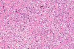 Apocrine type intraductal carcinoma with invasion