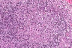 Apocrine type intraductal carcinoma with invasion