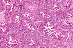 Oncocytic type intraductal carcinoma