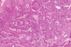 Oncocytic type intraductal carcinoma