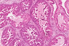 Oncocytic type intraductal carcinoma