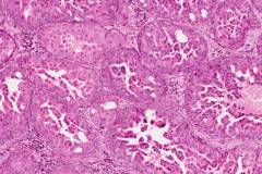 Oncocytic type intraductal carcinoma