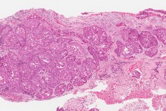 Oncocytic type intraductal carcinoma