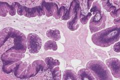 Intraductal papillary mucinous neoplasm of the pancreas