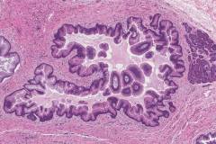 Intraductal papillary mucinous neoplasm of the pancreas