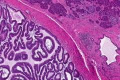 Intraductal papillary mucinous neoplasm of the pancreas