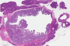 Intraductal papillary mucinous neoplasm of the pancreas