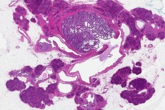 Intraductal papillary mucinous neoplasm of the pancreas