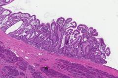 Intraductal papillary mucinous neoplasm of the pancreas