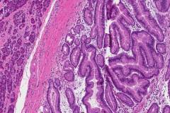 Intraductal papillary mucinous neoplasm of the pancreas