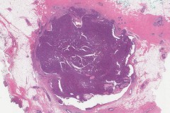 Intraductal papilloma of the breast