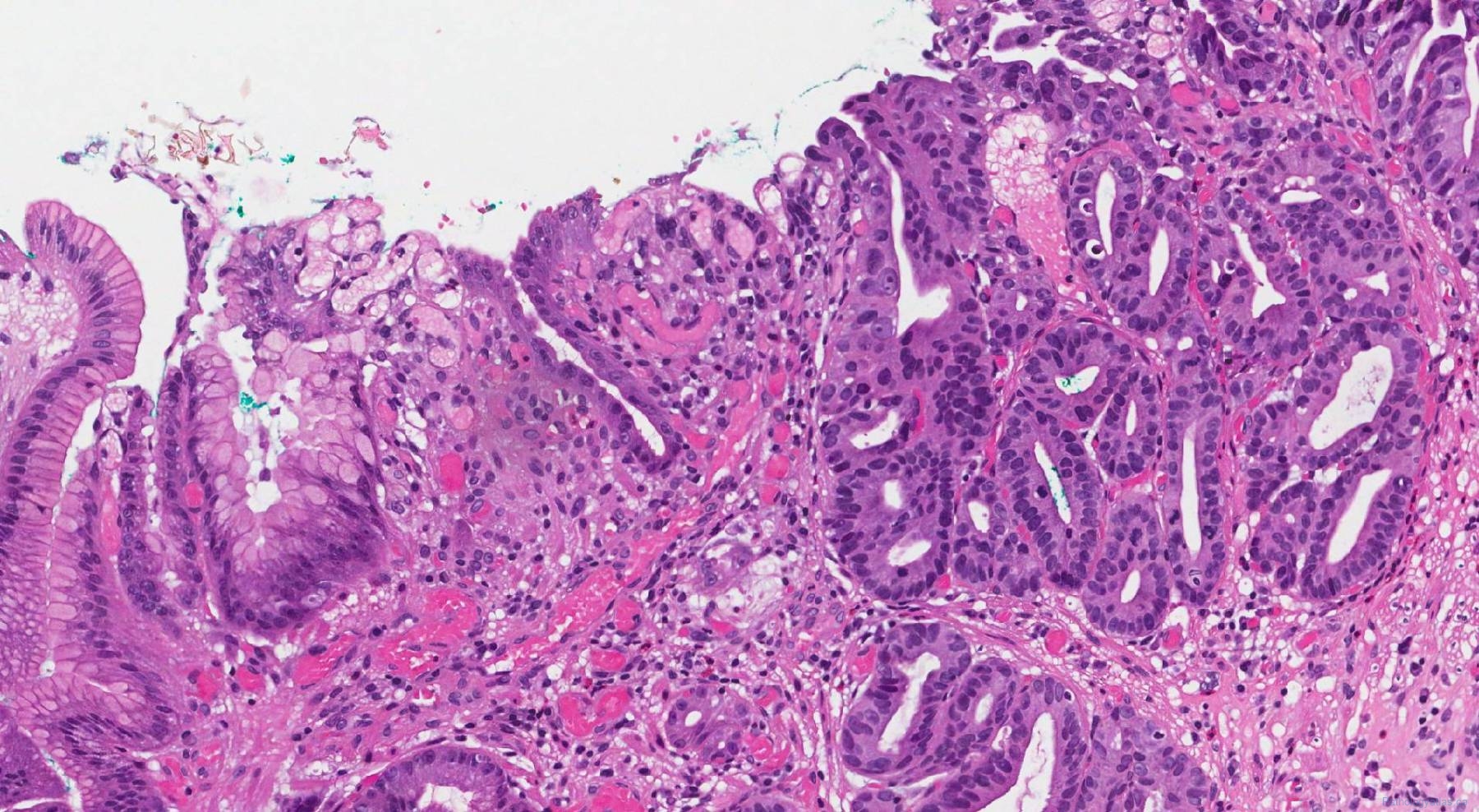 Intramucosal Adenocarcinoma Of The Stomach | Atlas Of Pathology