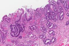 Intramucosal adenocarcinoma of the stomach