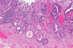 Intramucosal adenocarcinoma of the stomach