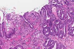 Intramucosal adenocarcinoma of the stomach