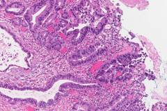 Intramucosal adenocarcinoma of the stomach