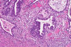 Intramucosal adenocarcinoma of the stomach