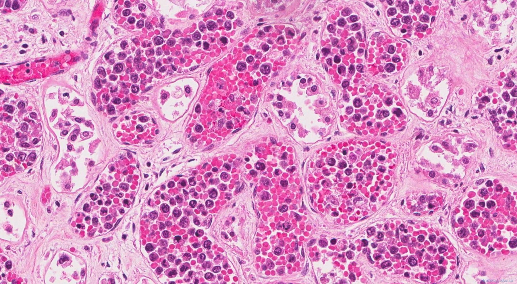 Intravascular Diffuse Large B Cell Lymphoma | Ottawa Atlas Of Pathology