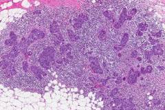 Invasive ductal carcinoma arising from ductal carcinoma in situ of the breast