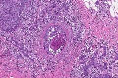 Invasive ductal carcinoma arising from ductal carcinoma in situ of the breast