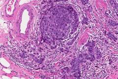 Invasive ductal carcinoma arising from ductal carcinoma in situ of the breast