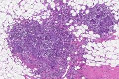 Invasive ductal carcinoma arising from ductal carcinoma in situ of the breast