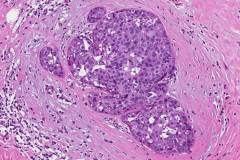 Invasive ductal carcinoma arising from ductal carcinoma in situ of the breast