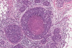 Invasive ductal carcinoma of the breast