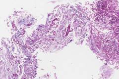 Invasive zygomycetes infection of the nasal cavity