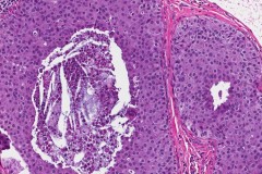 Pleomorphic lobular carcinoma in situ of the breast