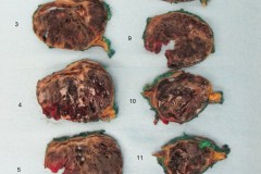 Metastatic melanoma involving the adrenal gland