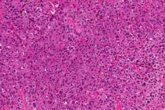 Metastatic melanoma from the skin to the brain