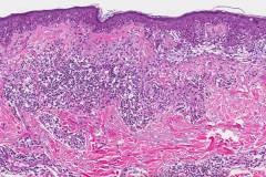 Invasive melanoma, lentigo melanoma type