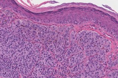 Invasive melanoma of the skin