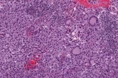 Invasive melanoma with multinucleated giant tumour cells