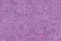 Invasive melanoma of the skin