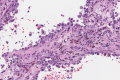 Metastatic melanoma from the skin to the adrenal gland