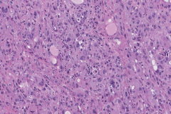 Metastatic melanoma from the skin to the adrenal gland