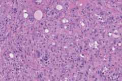 Metastatic melanoma from the skin to the adrenal gland