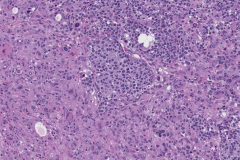 Metastatic melanoma from the skin to the adrenal gland