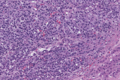 Metastatic melanoma from the skin to the adrenal gland