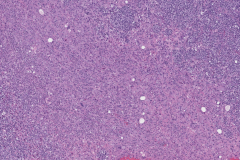 Metastatic melanoma from the skin to the adrenal gland