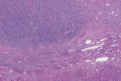 Metastatic melanoma from the skin to the adrenal gland