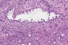 Metastatic melanoma from the skin to the adrenal gland