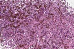 Metastatic melanoma to a lymph node