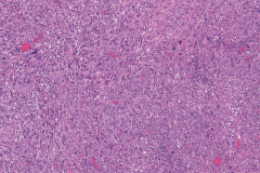 Metastatic melanoma from the skin