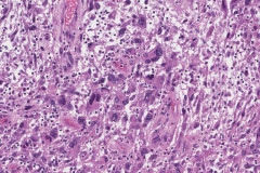 Metastatic melanoma from the skin