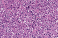 Metastatic melanoma from the skin