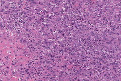 Metastatic melanoma from the skin